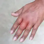 Como desinflamar una vena de un dedo?